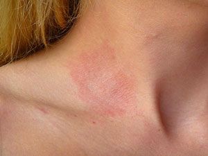 Contact Dermatitis: Symptoms, Causes, Types & Treatments